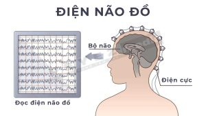 Điện não đồ